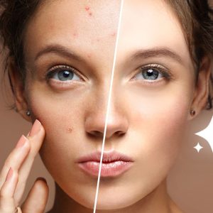 Blemish Retouching