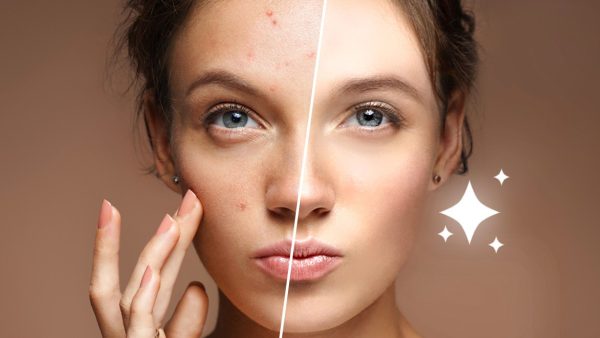 Blemish Retouching